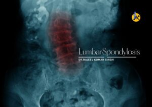 Back trauma and lumbar spondylosis – two degenerative conditions affecting the spine.